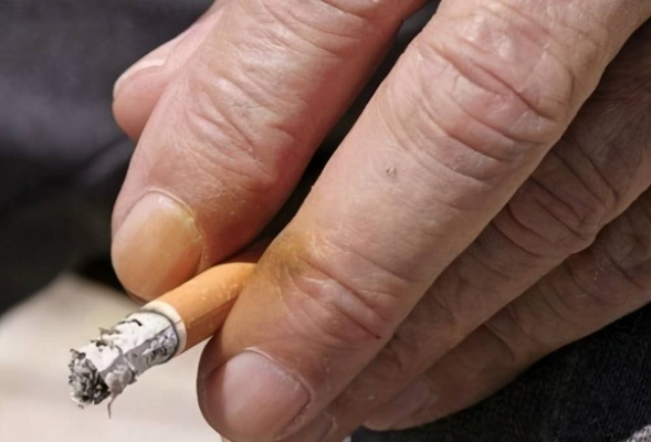 85岁老人抽烟60多年，脚趾发黑坏死，揭示吸烟对健康的严重危害