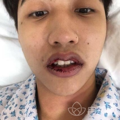 神秘突变，男子下唇厚一倍，颜值骤降成谜